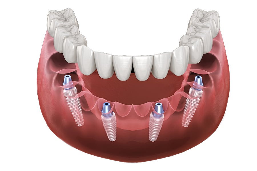 Grafik All-on-4-feste Zähne an einem Tag