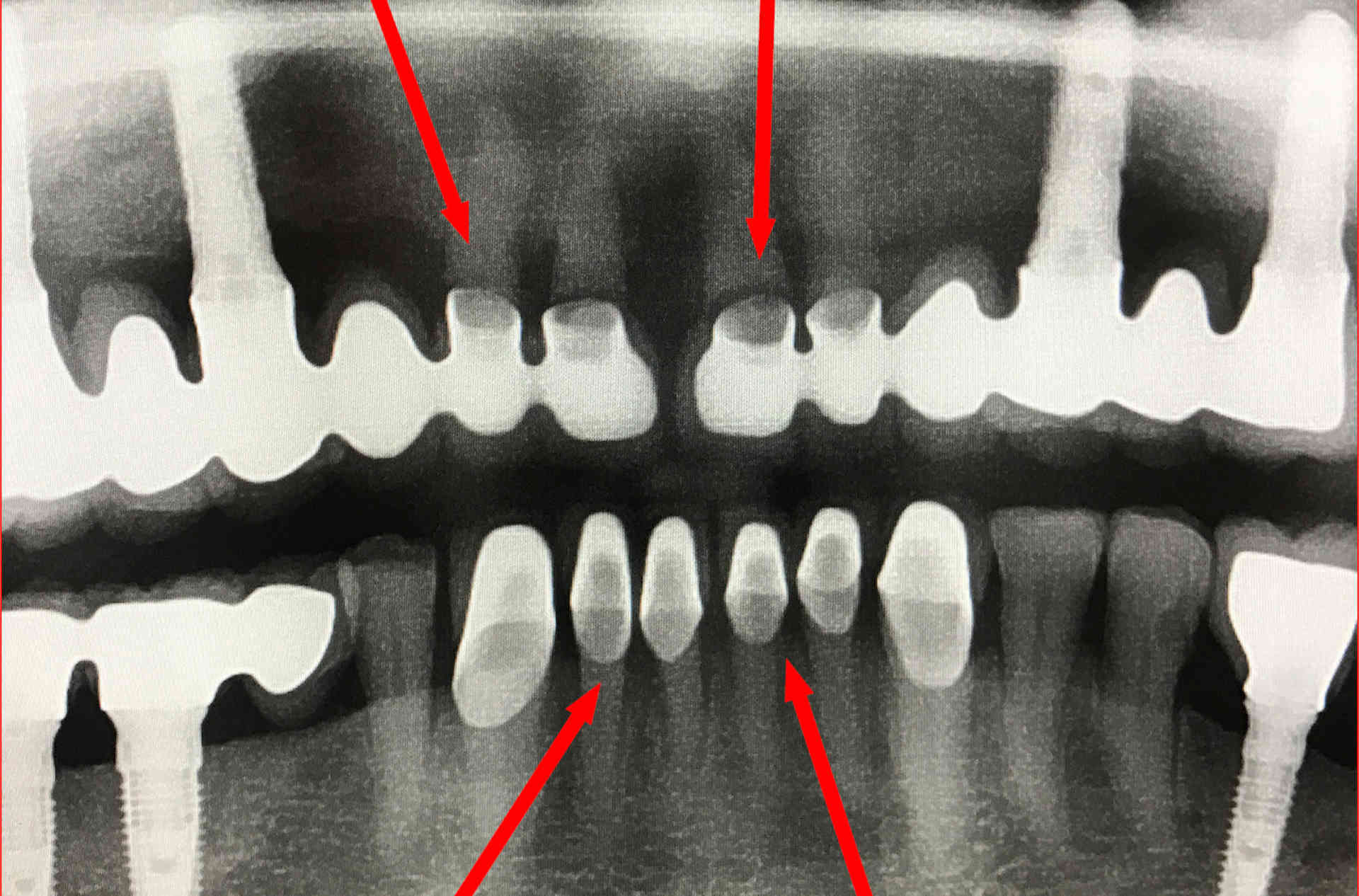 Röntgenbild einer verpfuschten Zahnbehandlung im Ausland