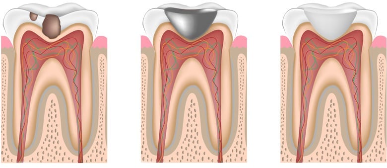 Grafik Karies Amalgam Weiße Zahnfüllung