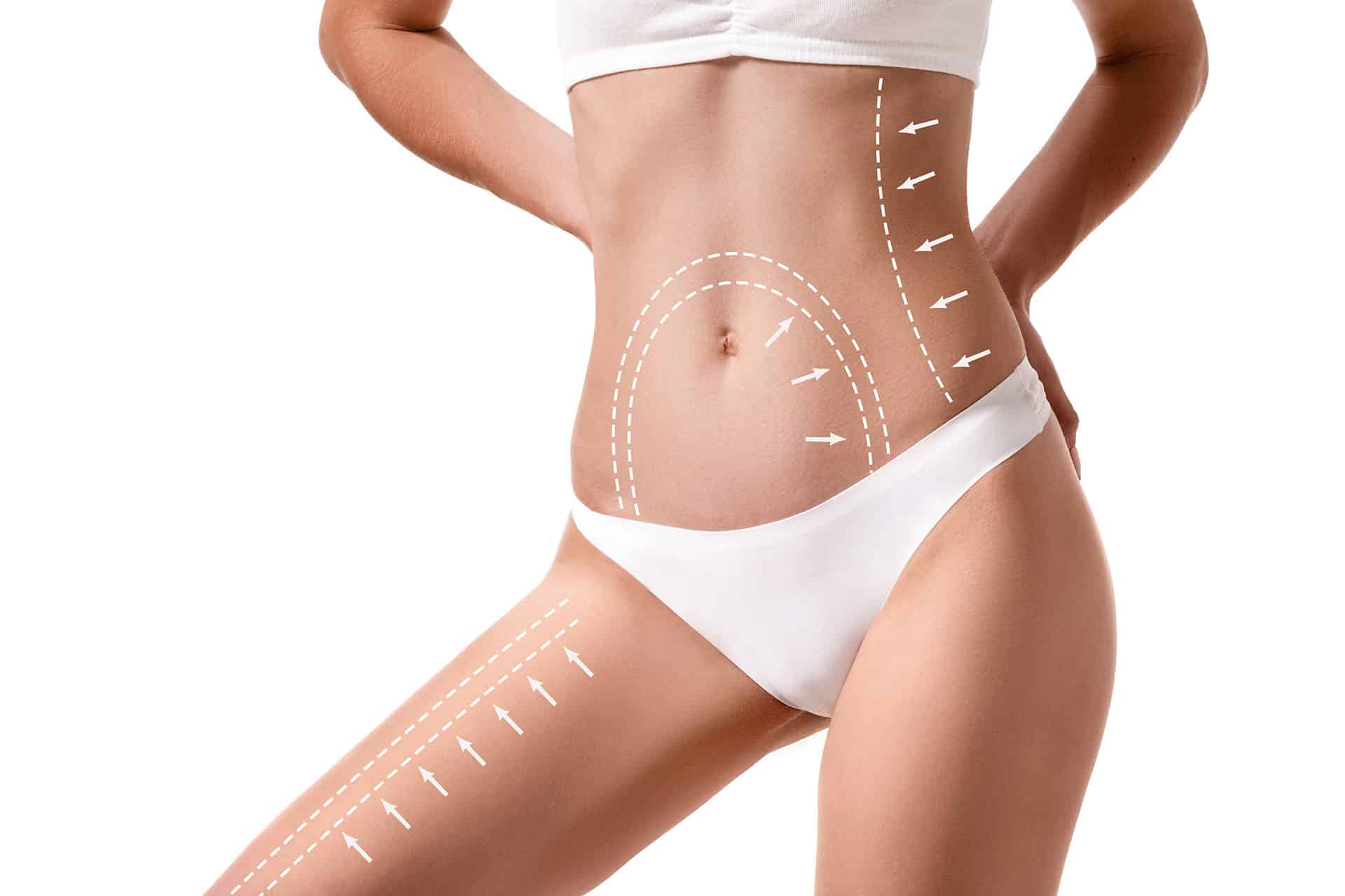 High Definition Liposuction
