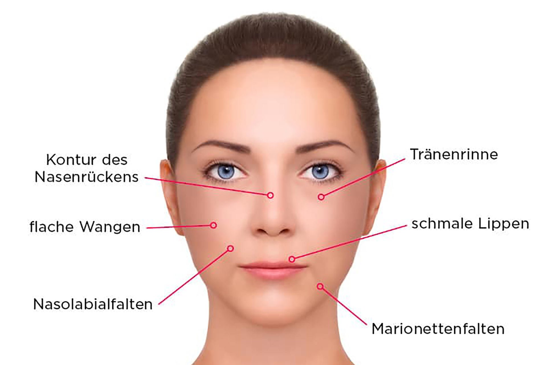 Weelche Bereiche im Gesicht können unterspritzt werden