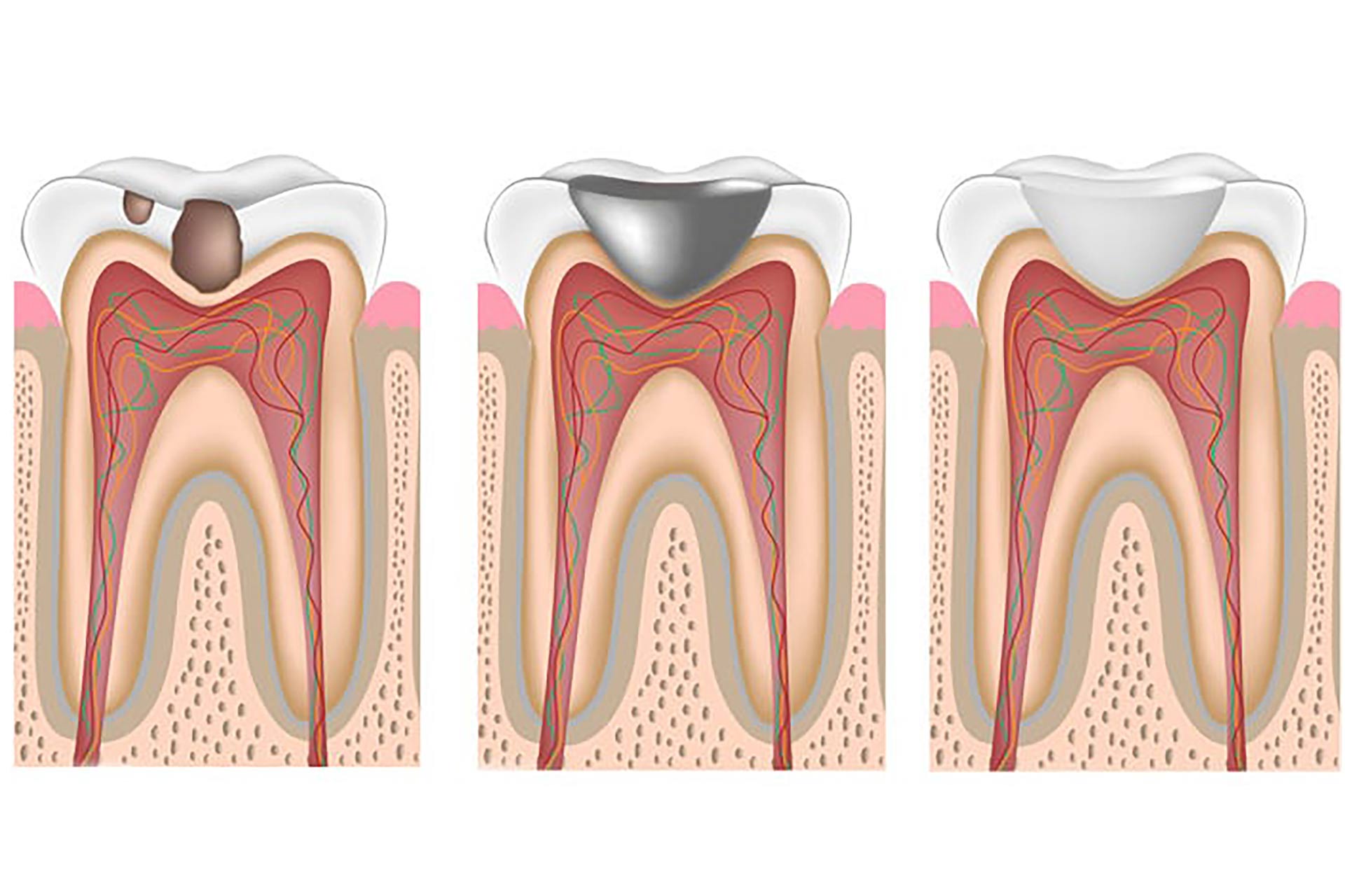 Weiße Zahnfüllungen Grafik zur Veranschaulichung