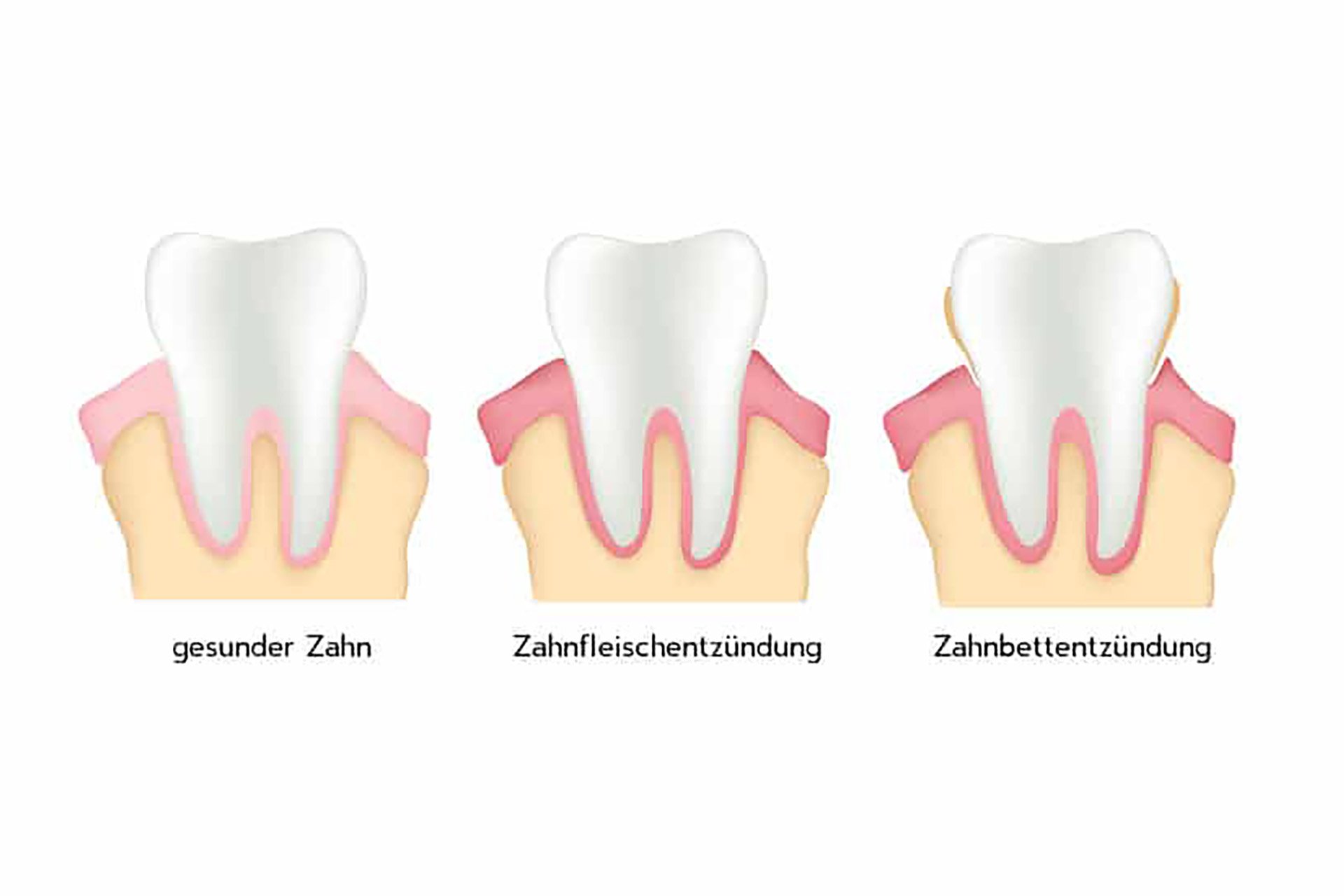 Zahnfleischentzündung Dentalhygiene Grafik