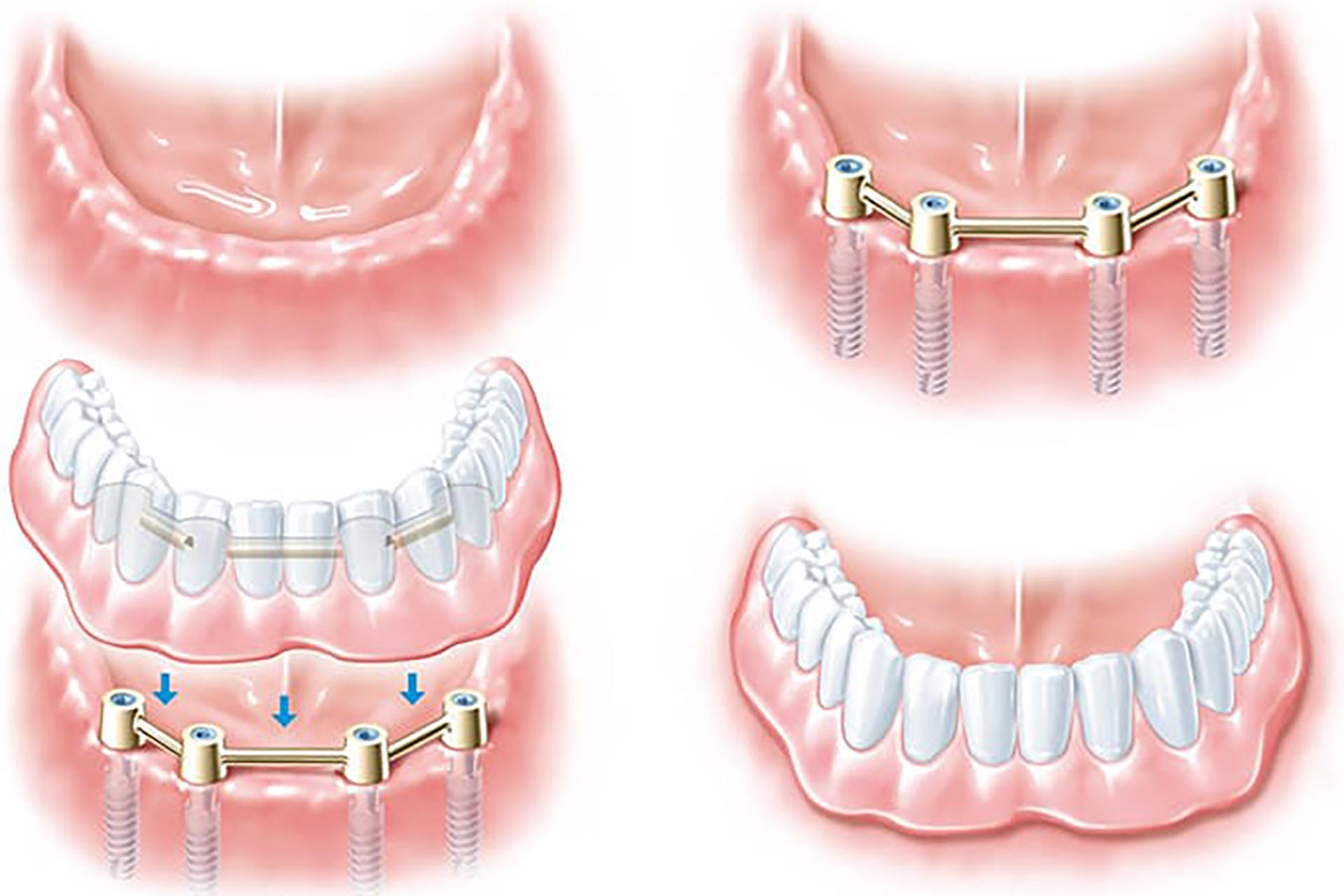 Grafik zeigt in vier Schritten den implantatgetragenen Zahnersatz