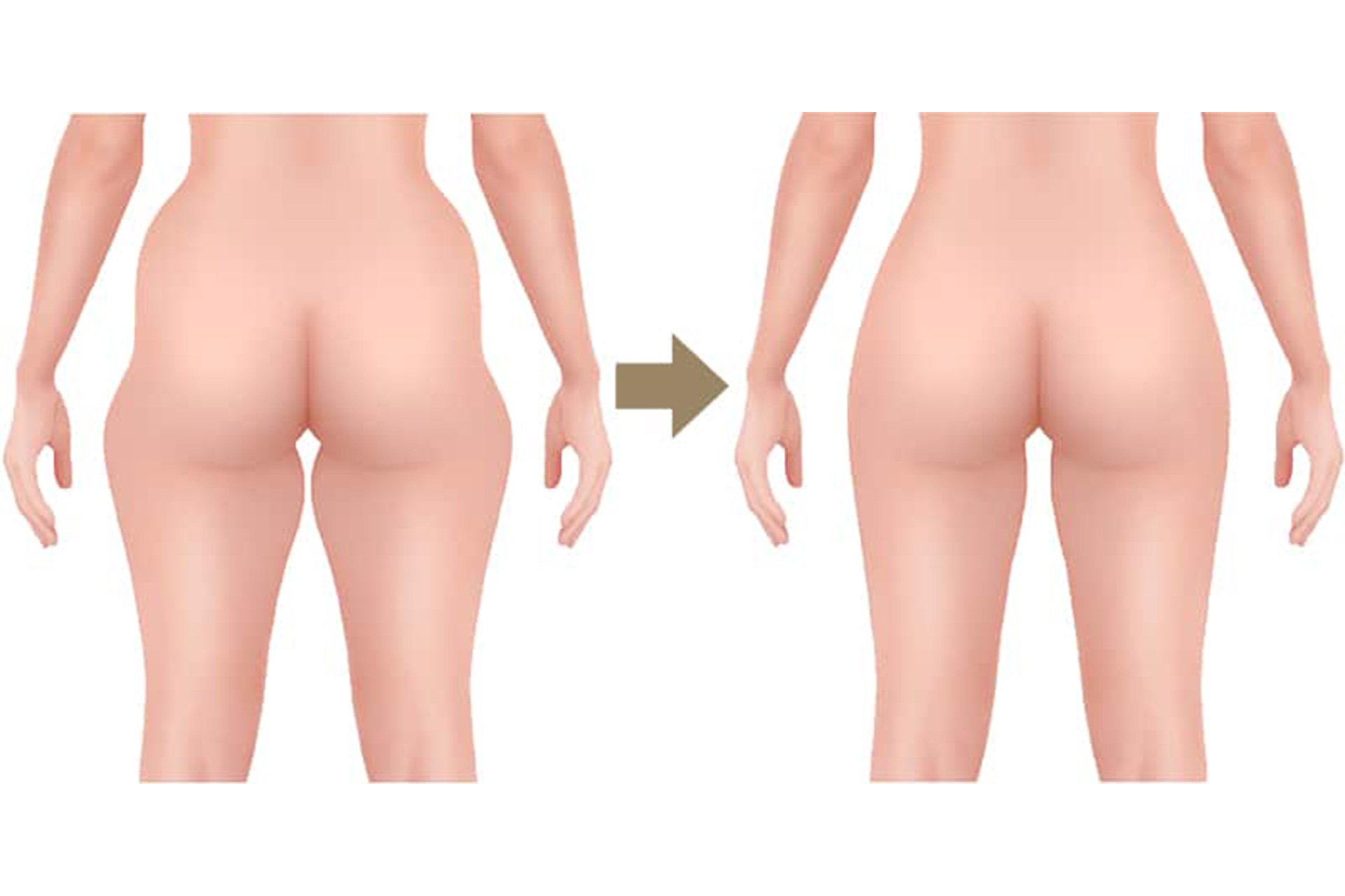 Illustration Figurformung nach Fettabsaugung