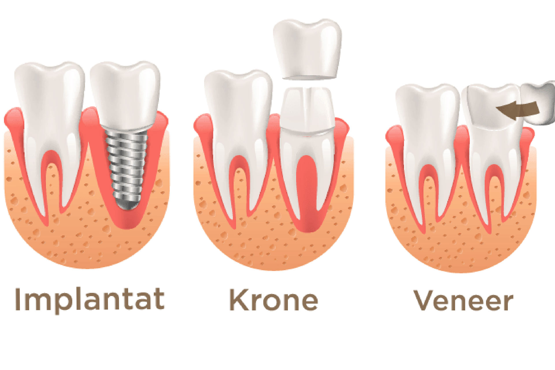 Grafik für Veneers, Kronen und Zahnimplantate