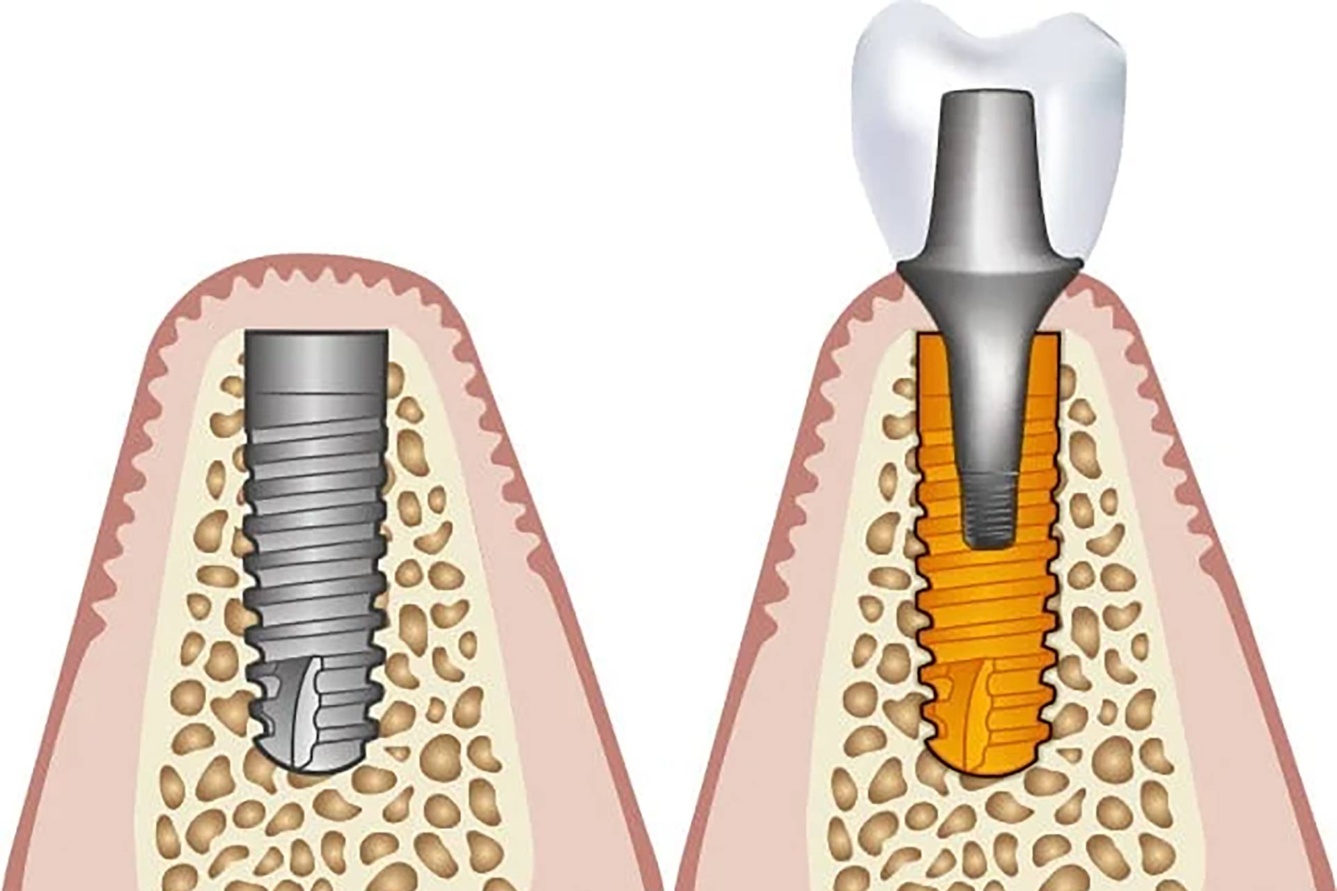 Grafik Zahnimplantat Implantation