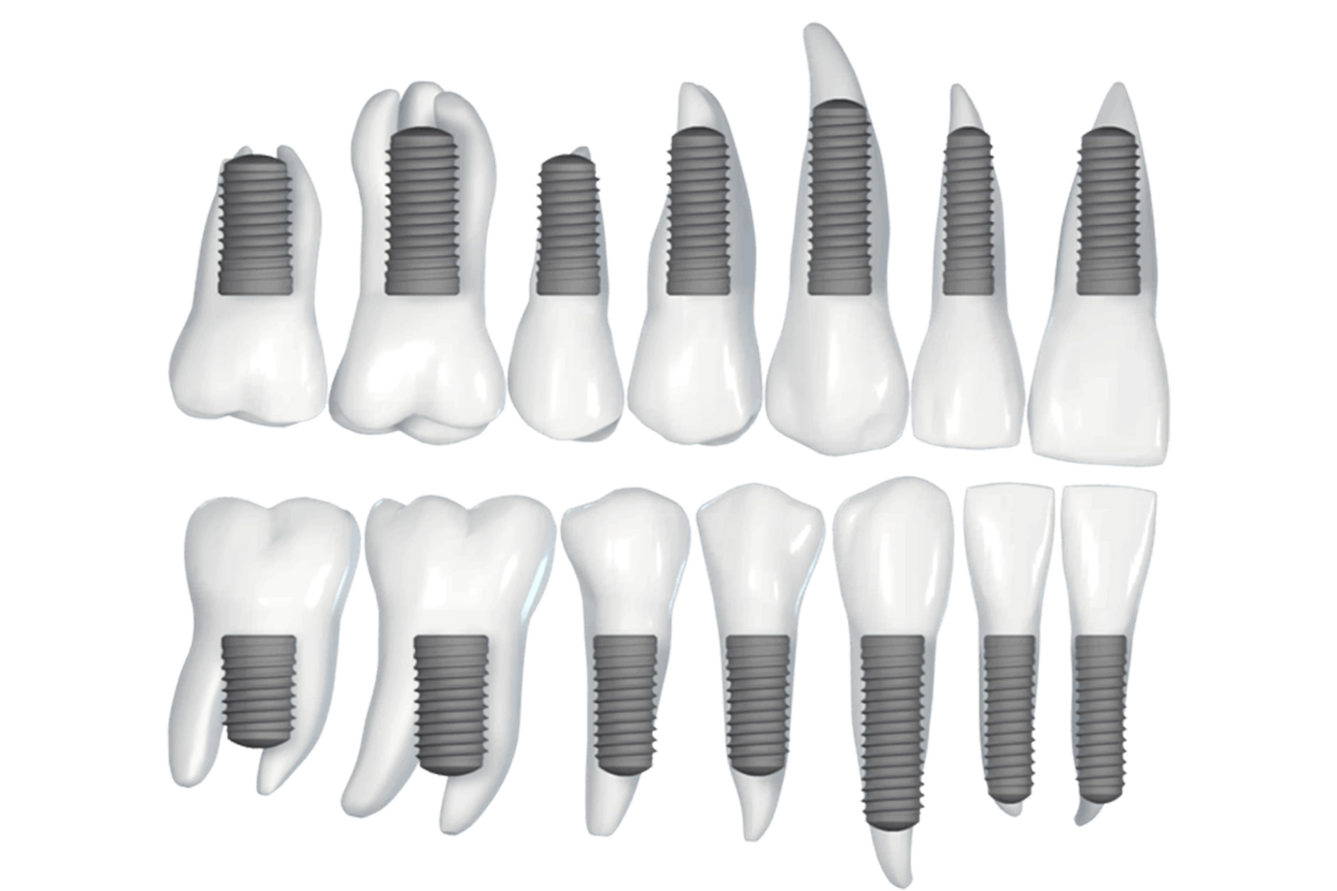 All-on-6 Zahnimplantate Grafik