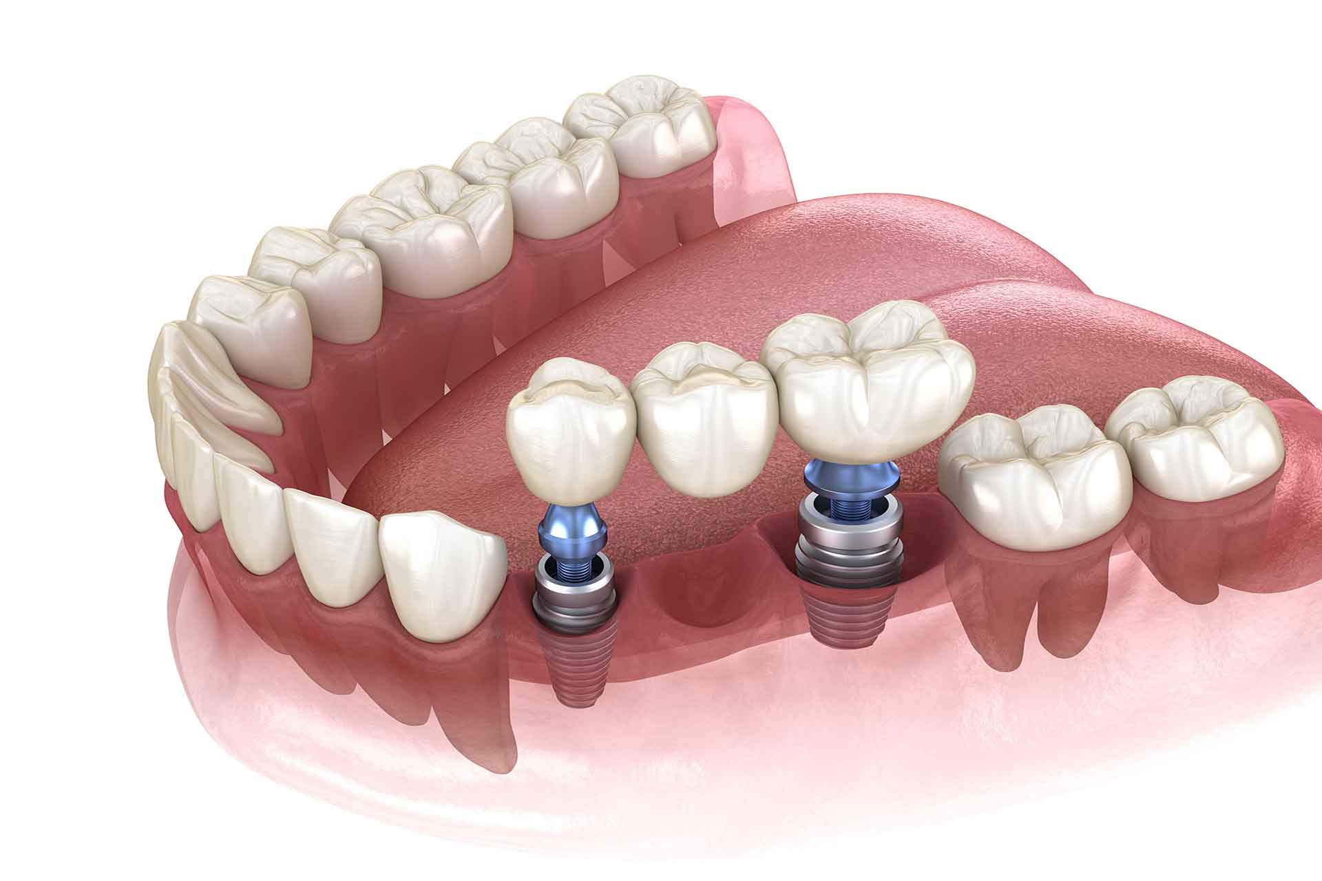 Implantatgetragene Zahnbrücke