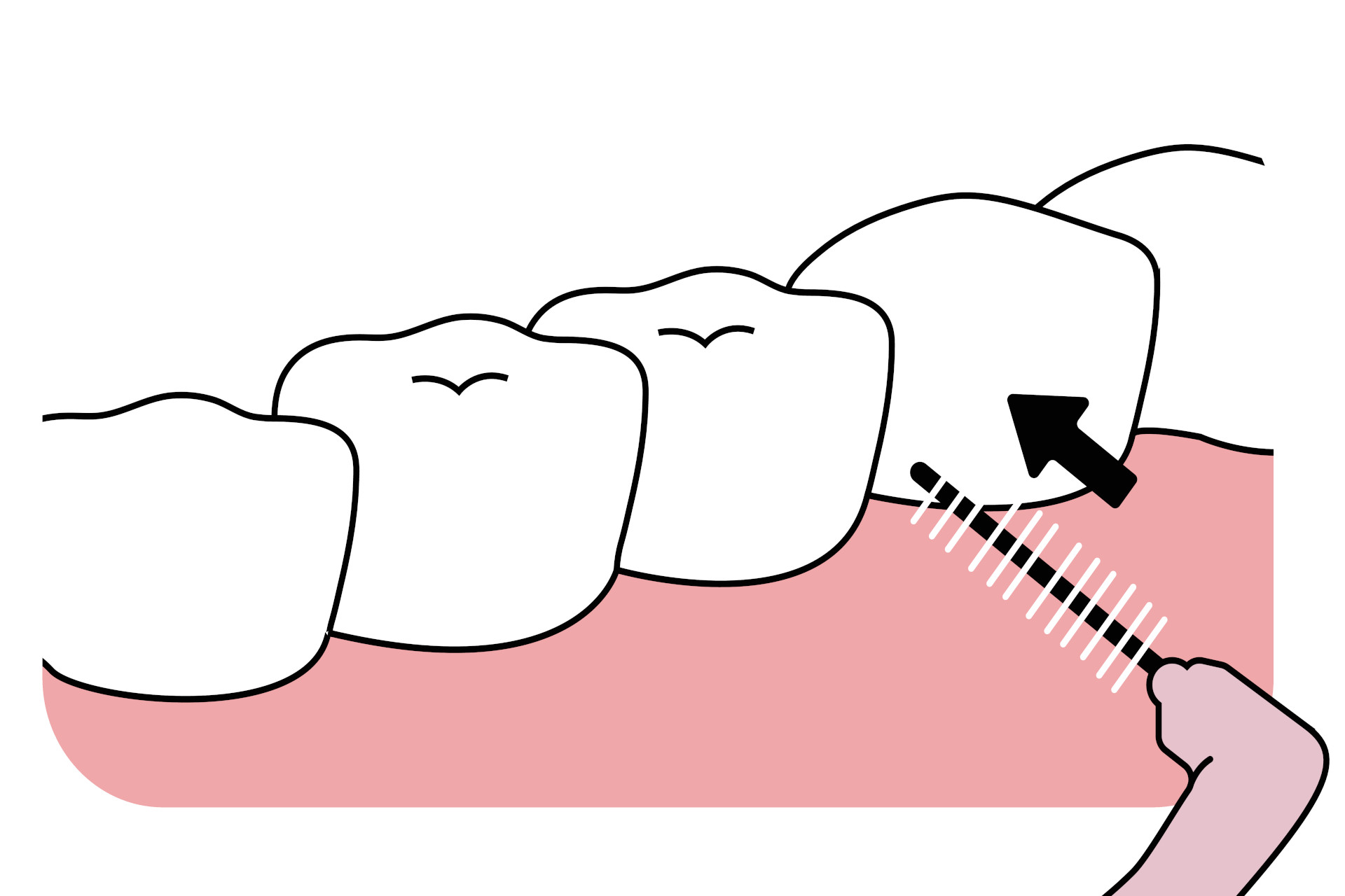 Interdentalbürste richtig verwenden grafische Darstellung