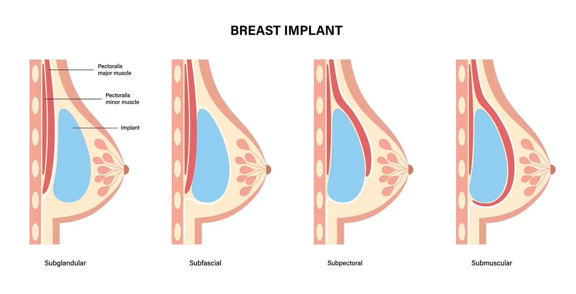 Implantatlage Grafik