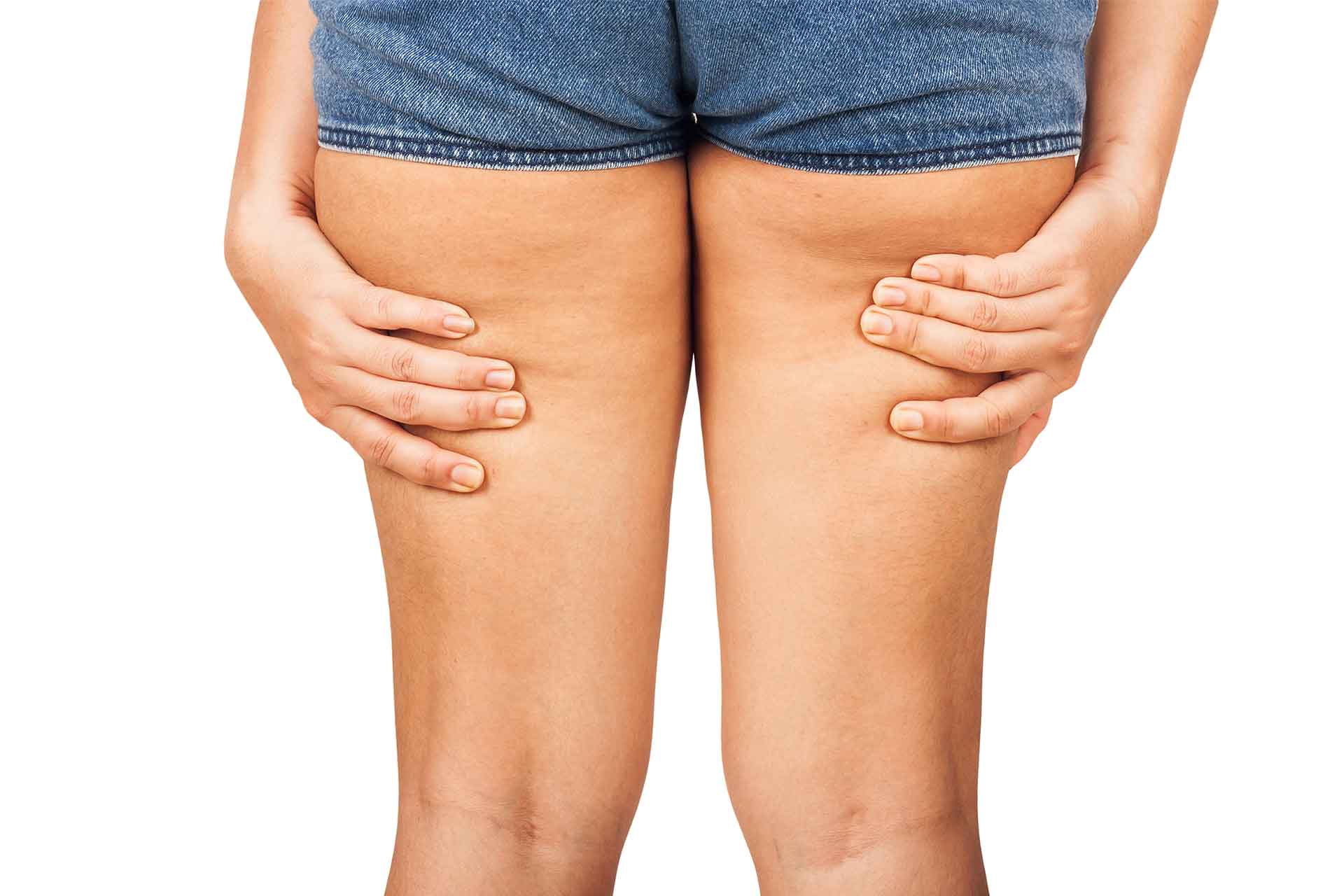 Hip Dips vs. Reiterhosen – was ist der Unterschied?