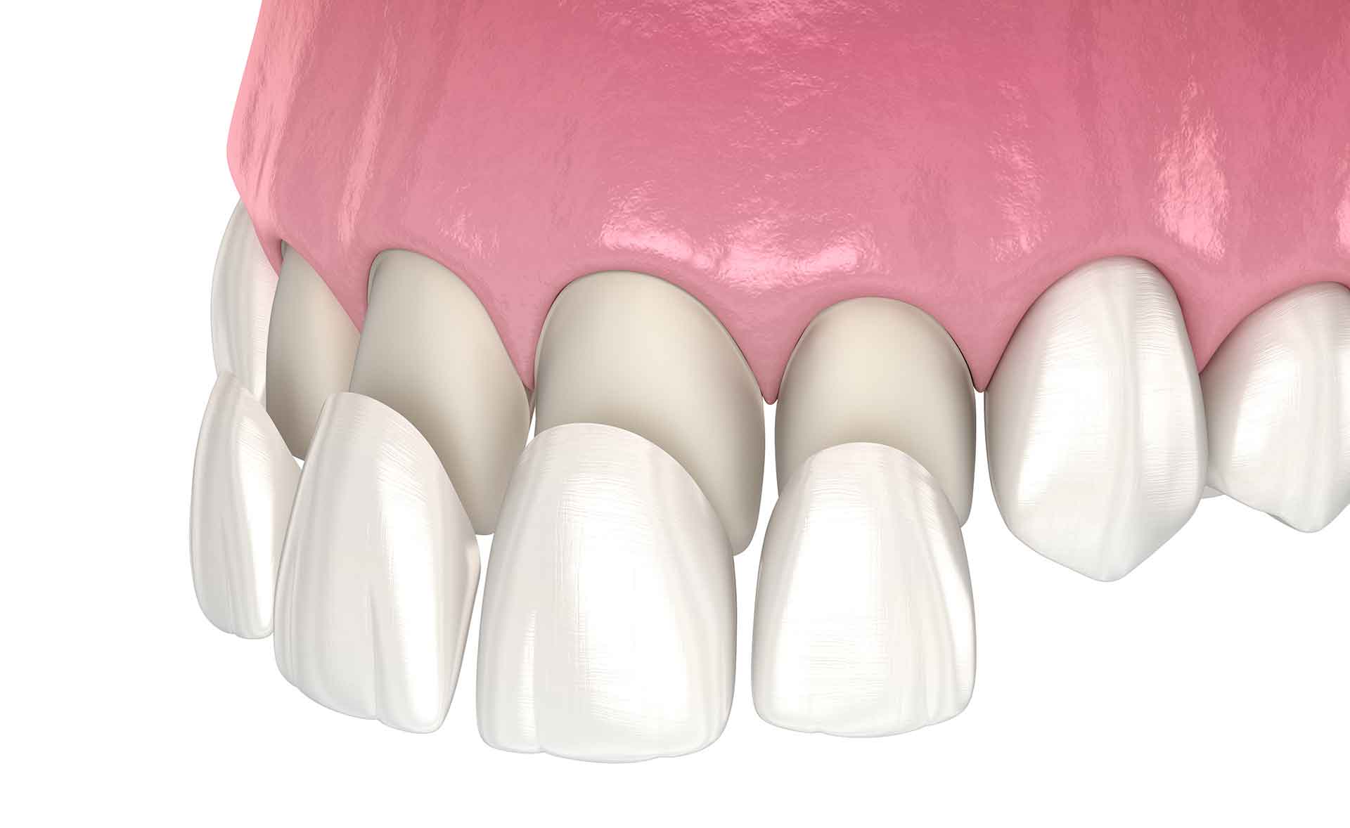 Veneers aus hochwertiger Keramik- grafische Darstellung