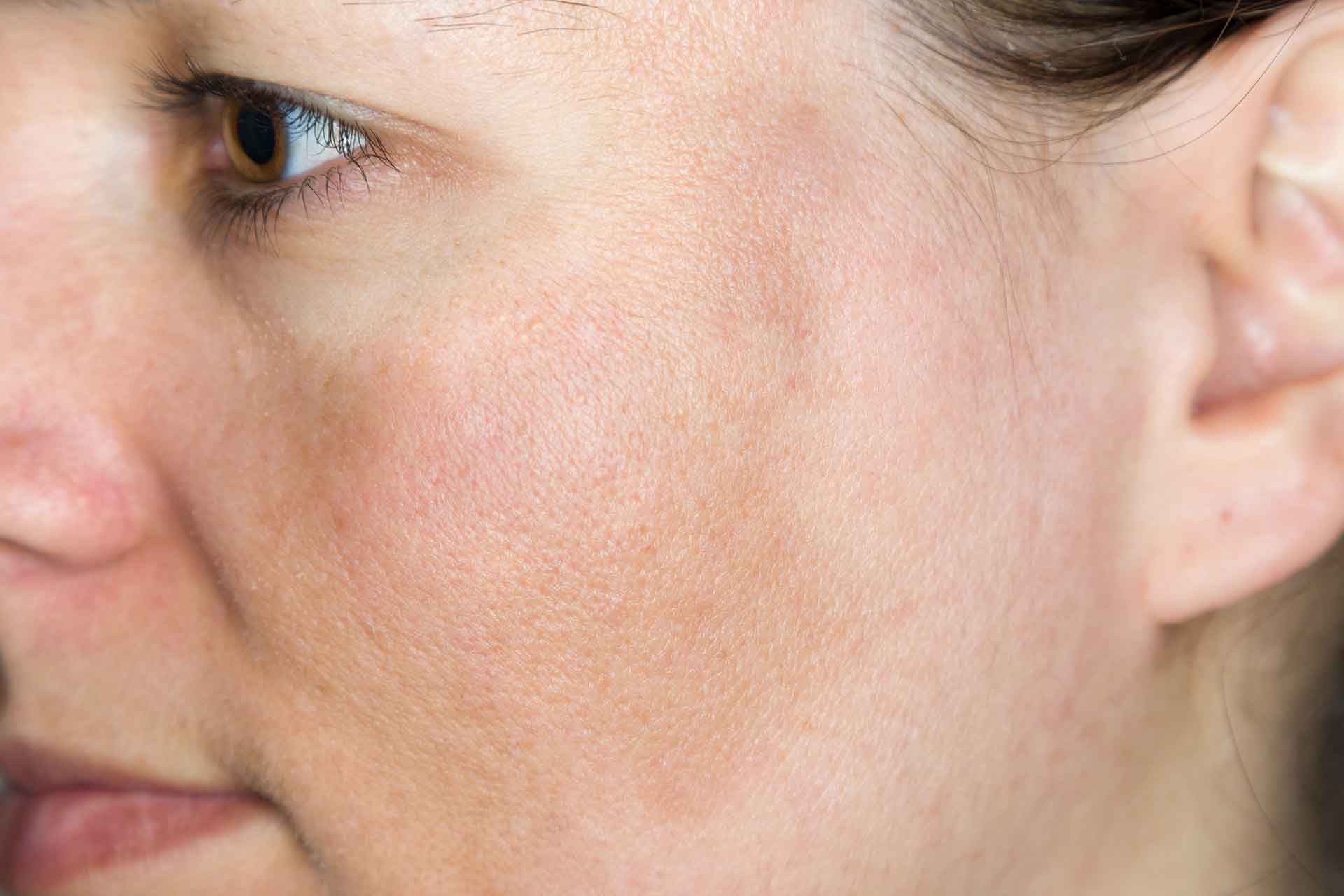 Pigmentflecken nach starker UV-Strahlung