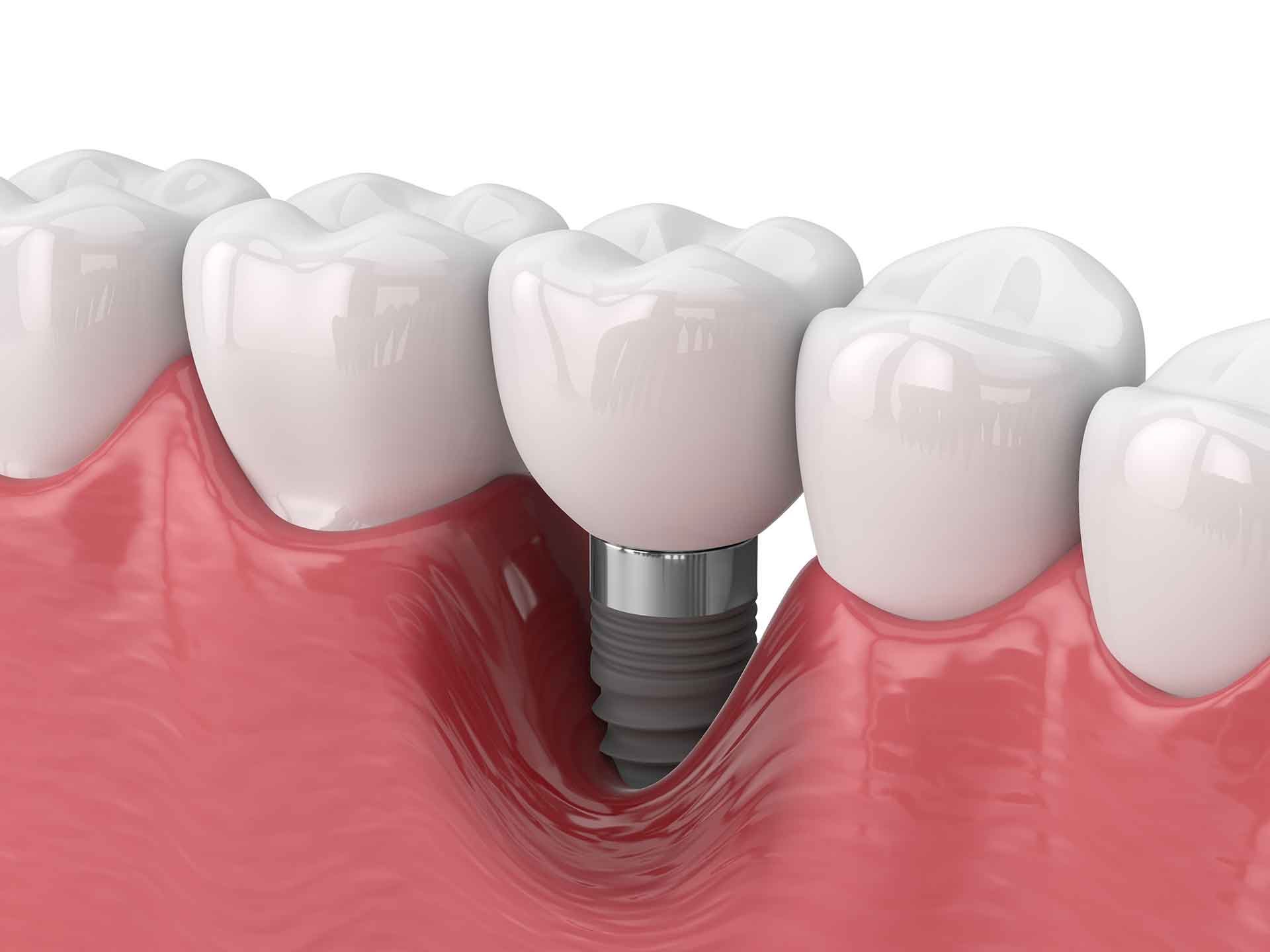 Implantatverlust bei Periimplantitis