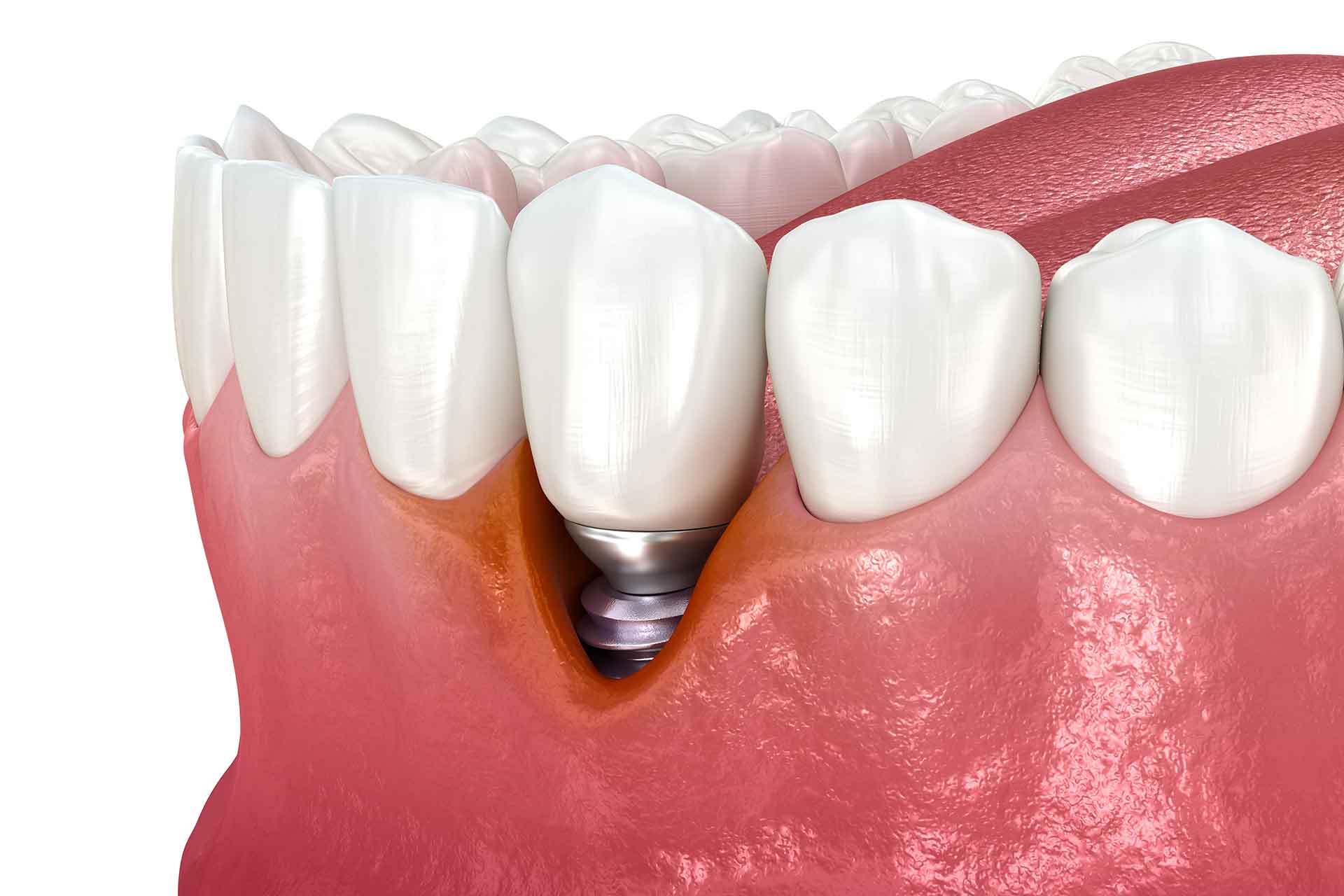 Periimplantitis - Entzündung am Implantat