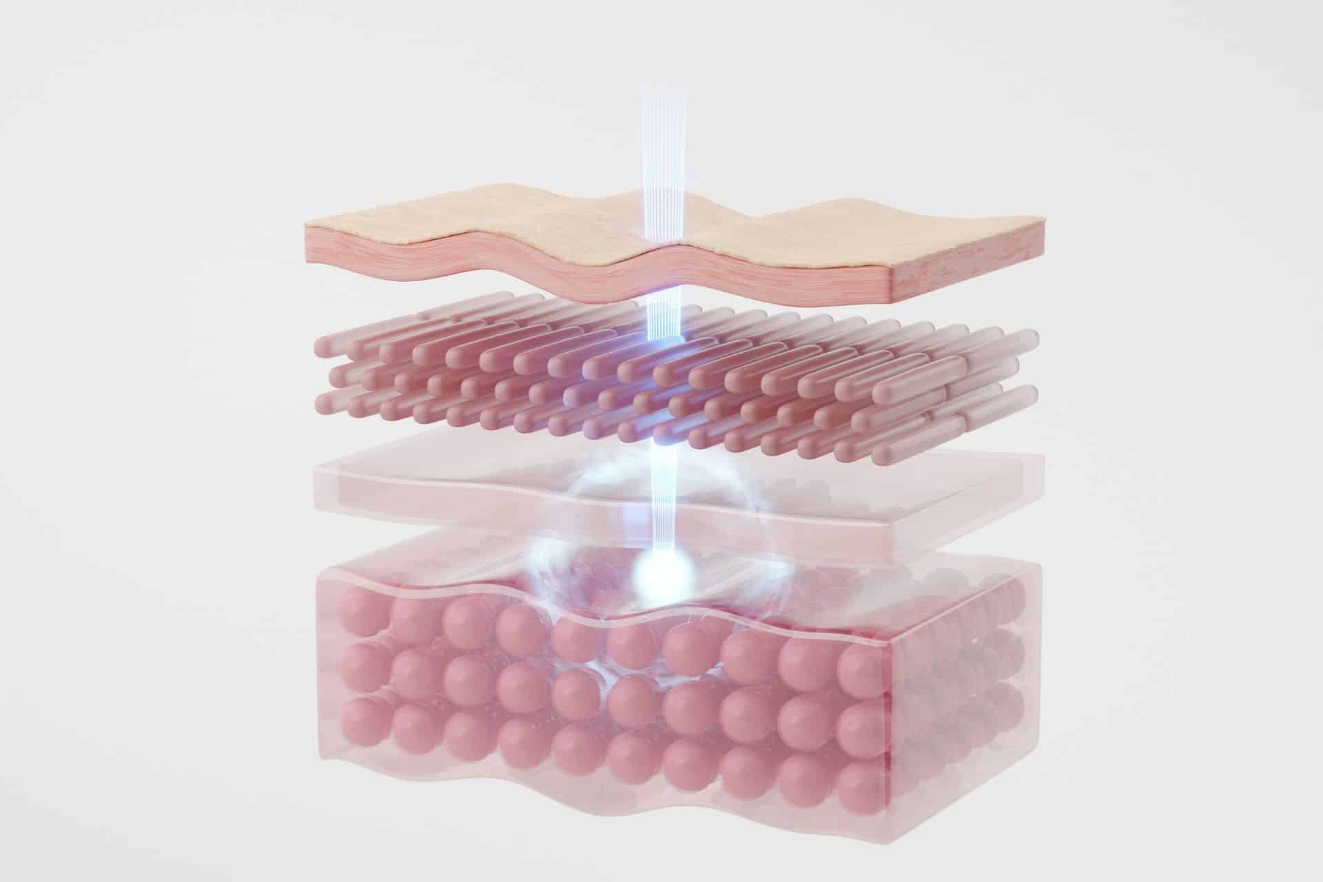 Tiefe Hautschichten, die der CO2-Laser erreicht