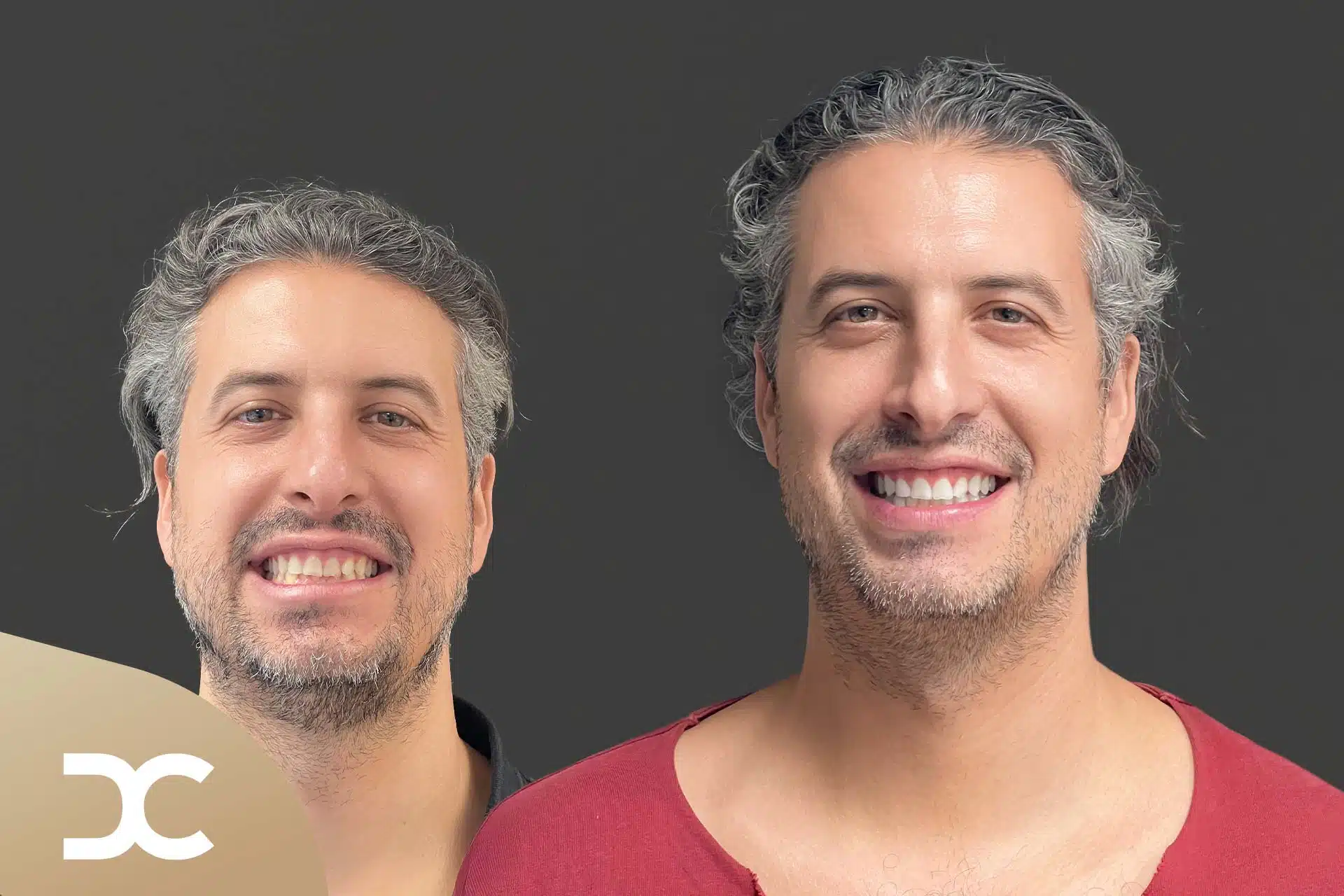 Bleaching nach Behandlung in der Dorow Clinic