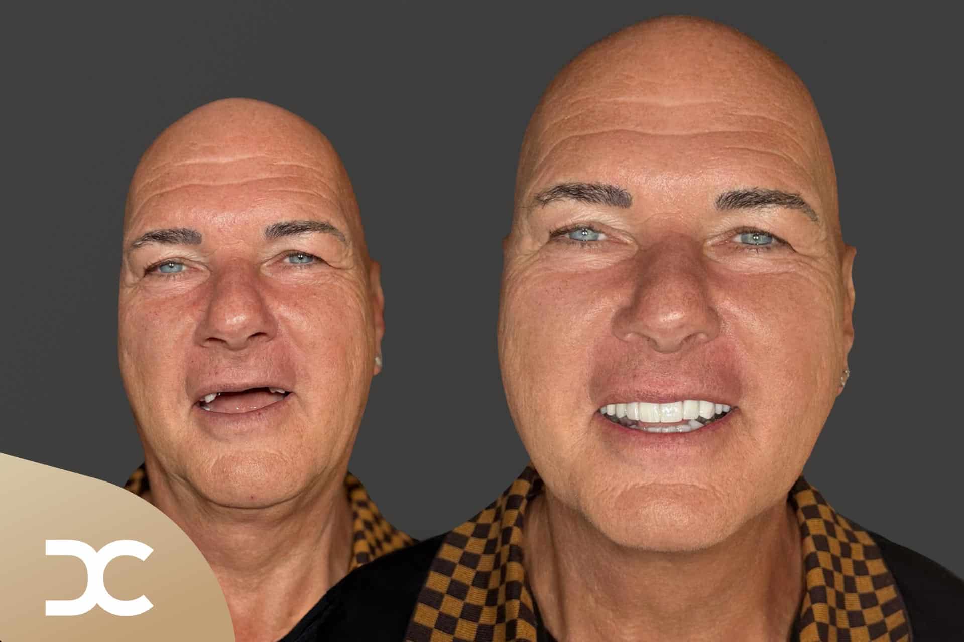 Brücke mit Implantaten bei Patient der Dorow Clinic.