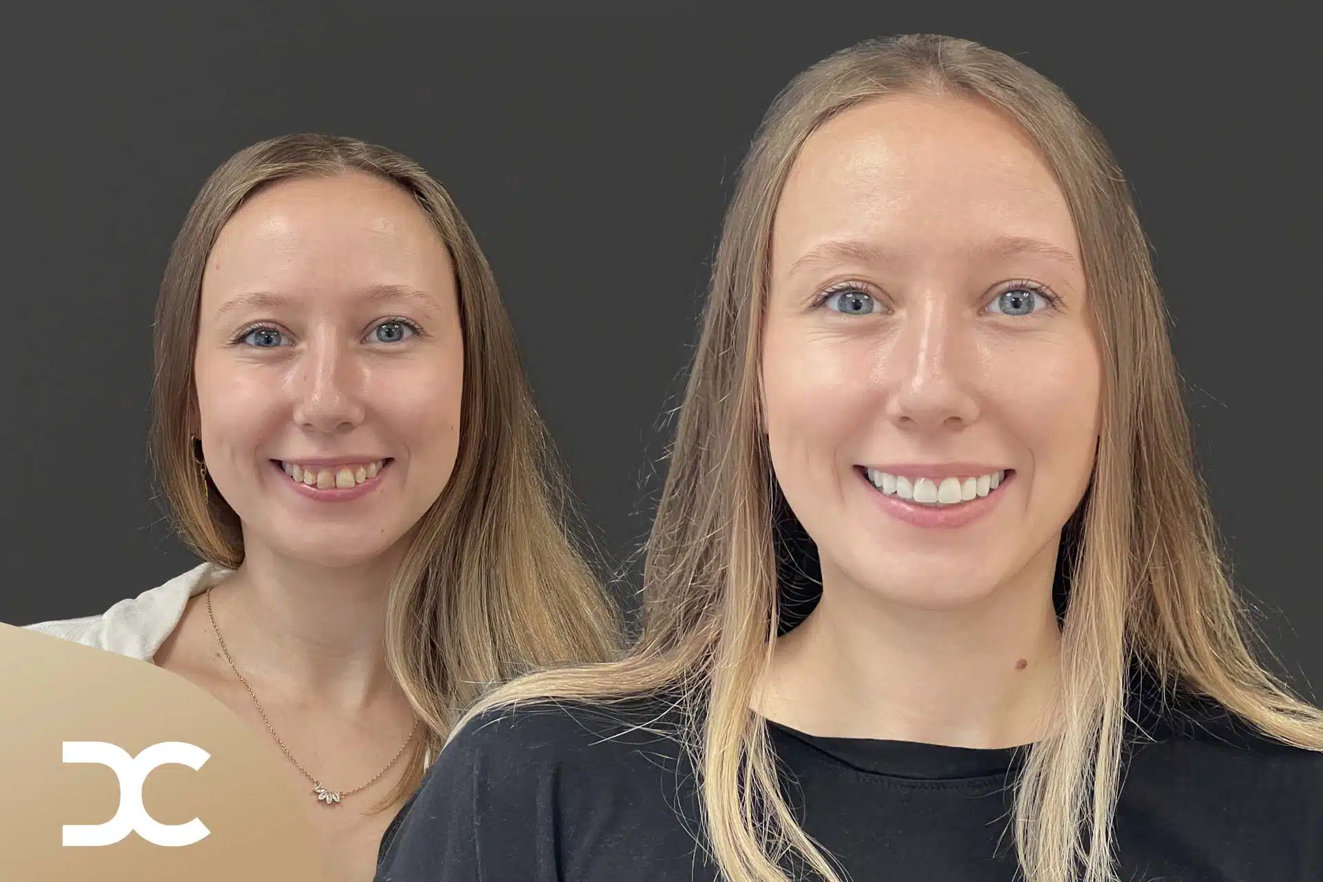 Ergebnis nach Zirkonkronen bei der Dorow Clinic.