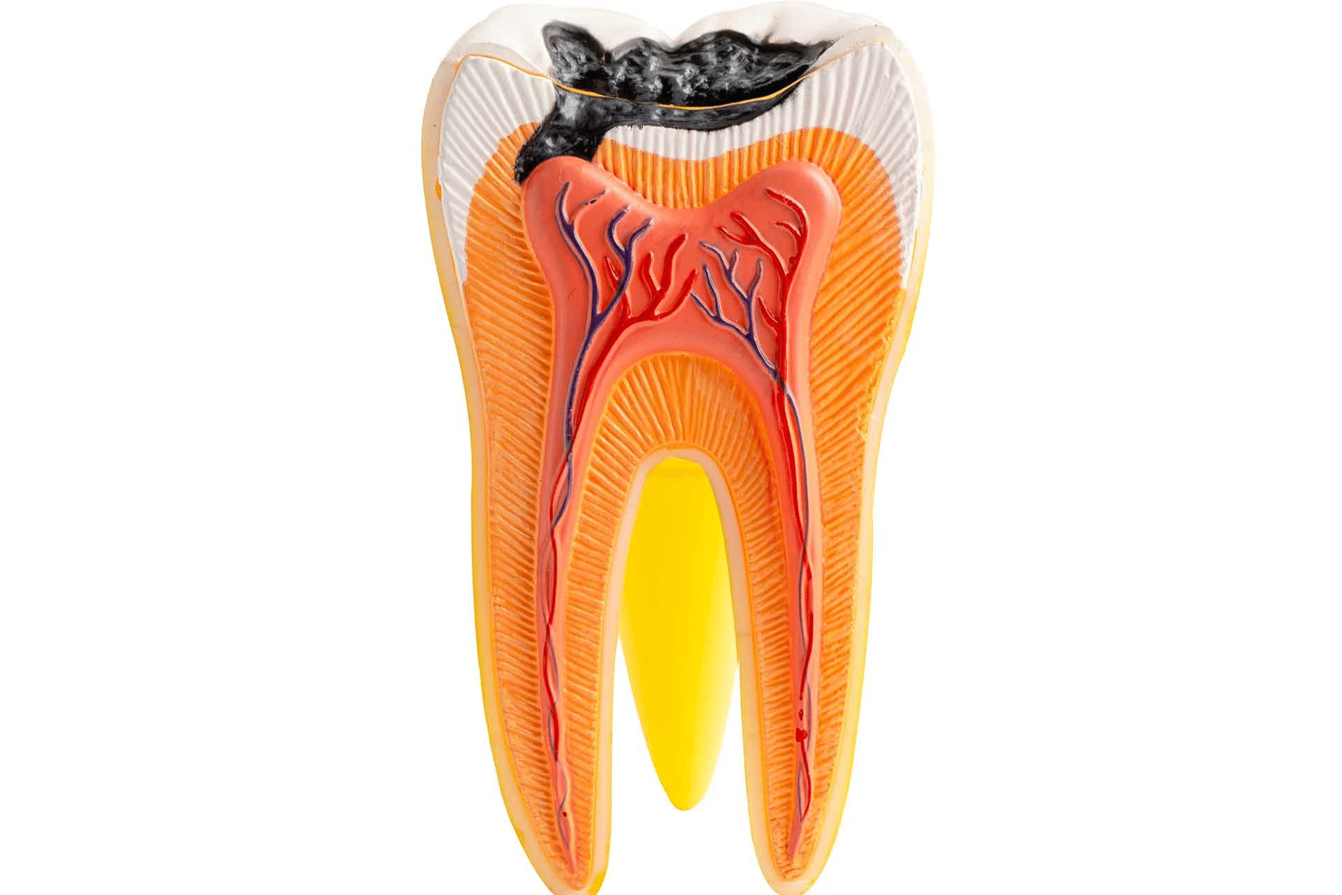 Karies am Weisheitszahn