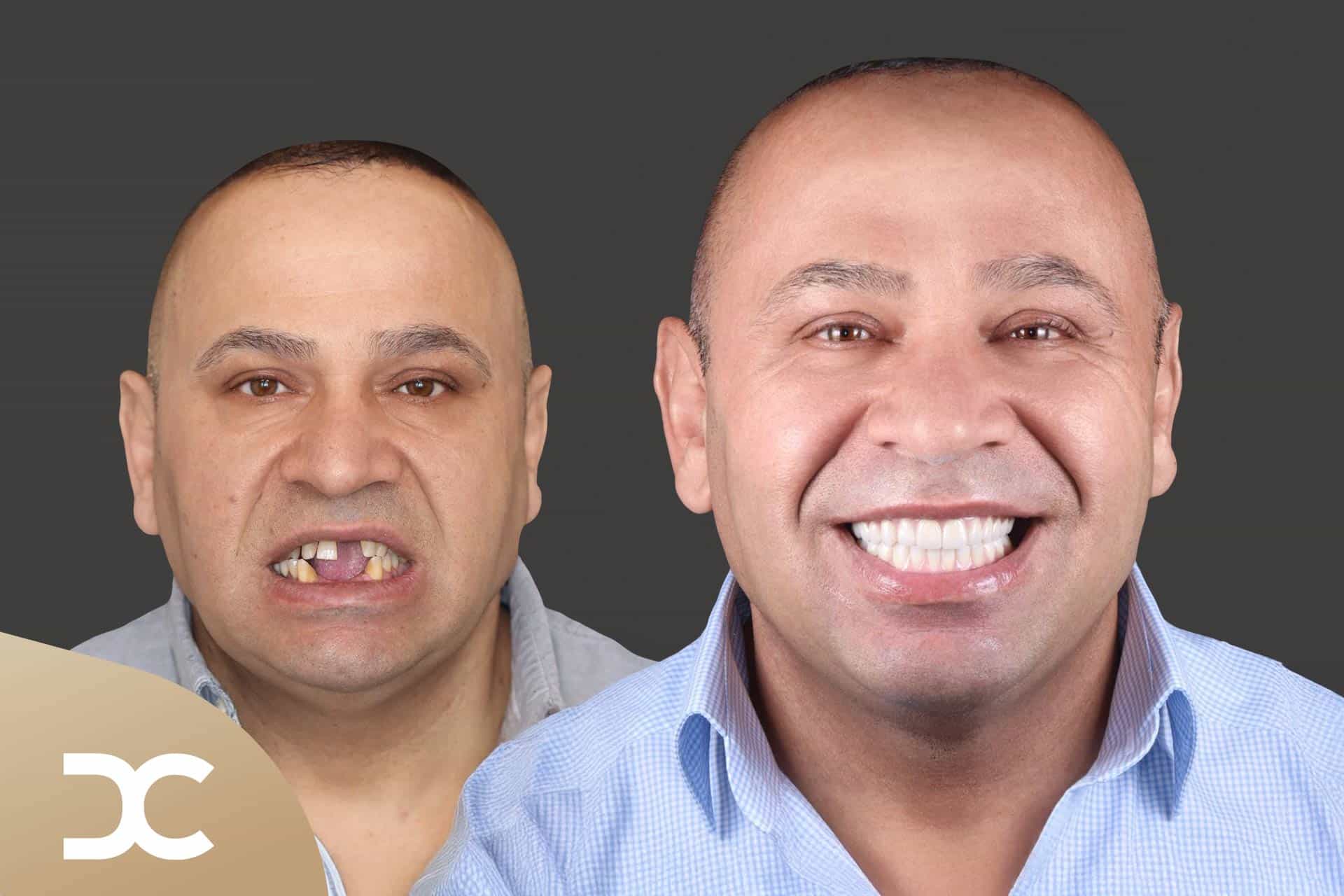 Komplett neues Lachen bei Patient der Dorow Clinic