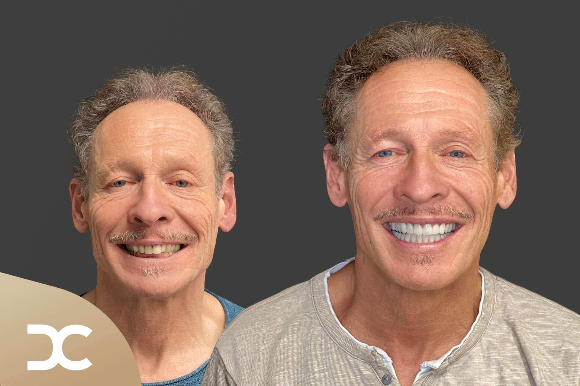 Mann strahlt nach Bleaching und Zahnreinigung in der Dorow Clinic