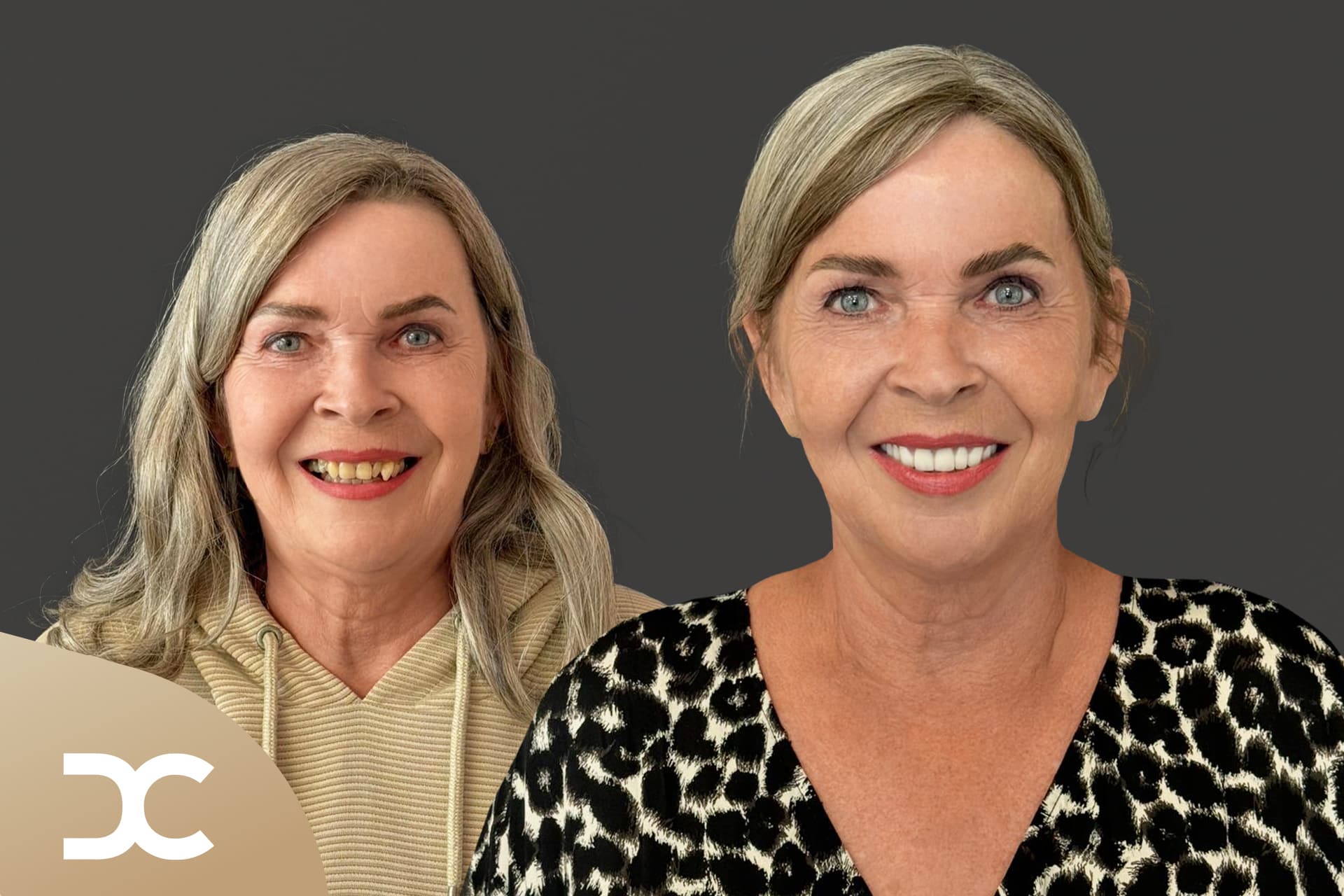 Neues Lächeln nach Paradontosebehandlung in der Dorow Clinic