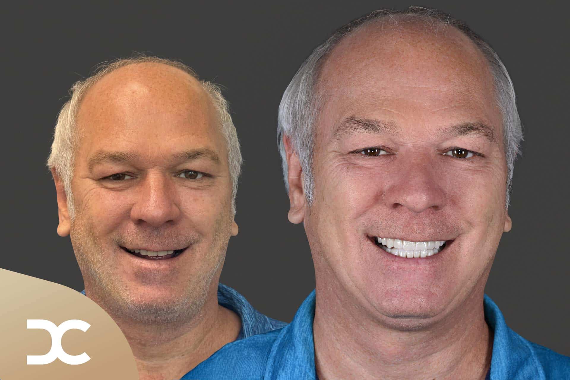 Rettung der Zähne nach jahrelanger Nutzung von fluoridfreier Zahnpasta