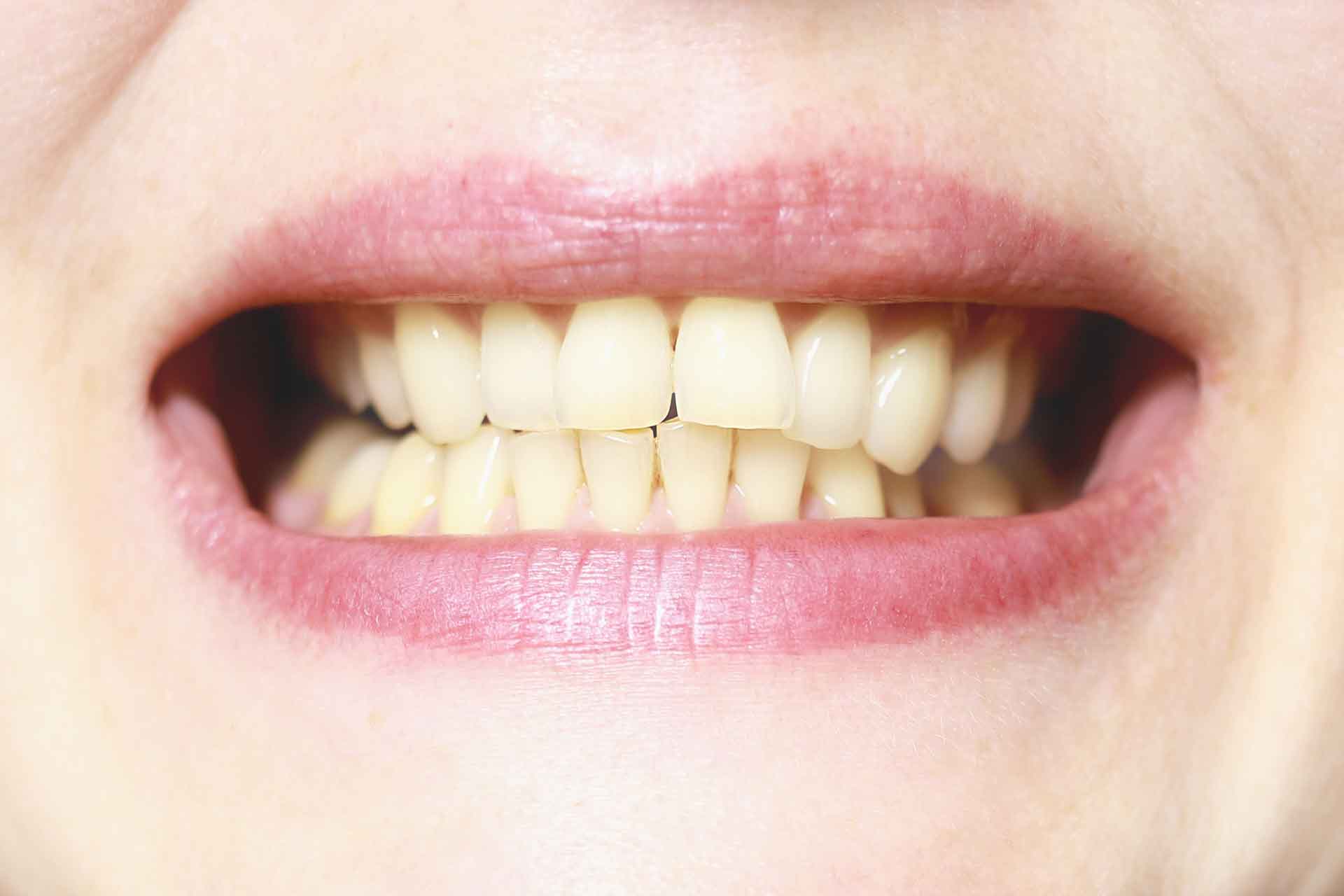 Schiefe Zähne durch Weisheitszahn