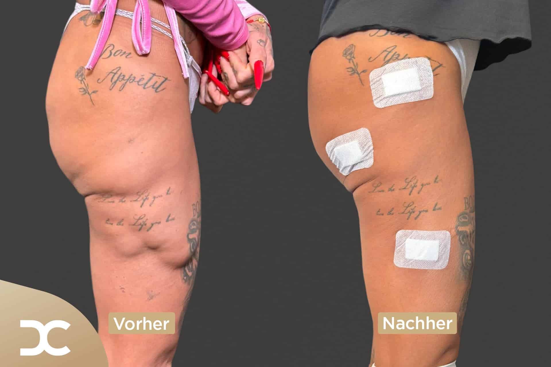 Ergebnis nach rettender Op bei Gina-Lisa Lohfink mit medizinischer Indikation.