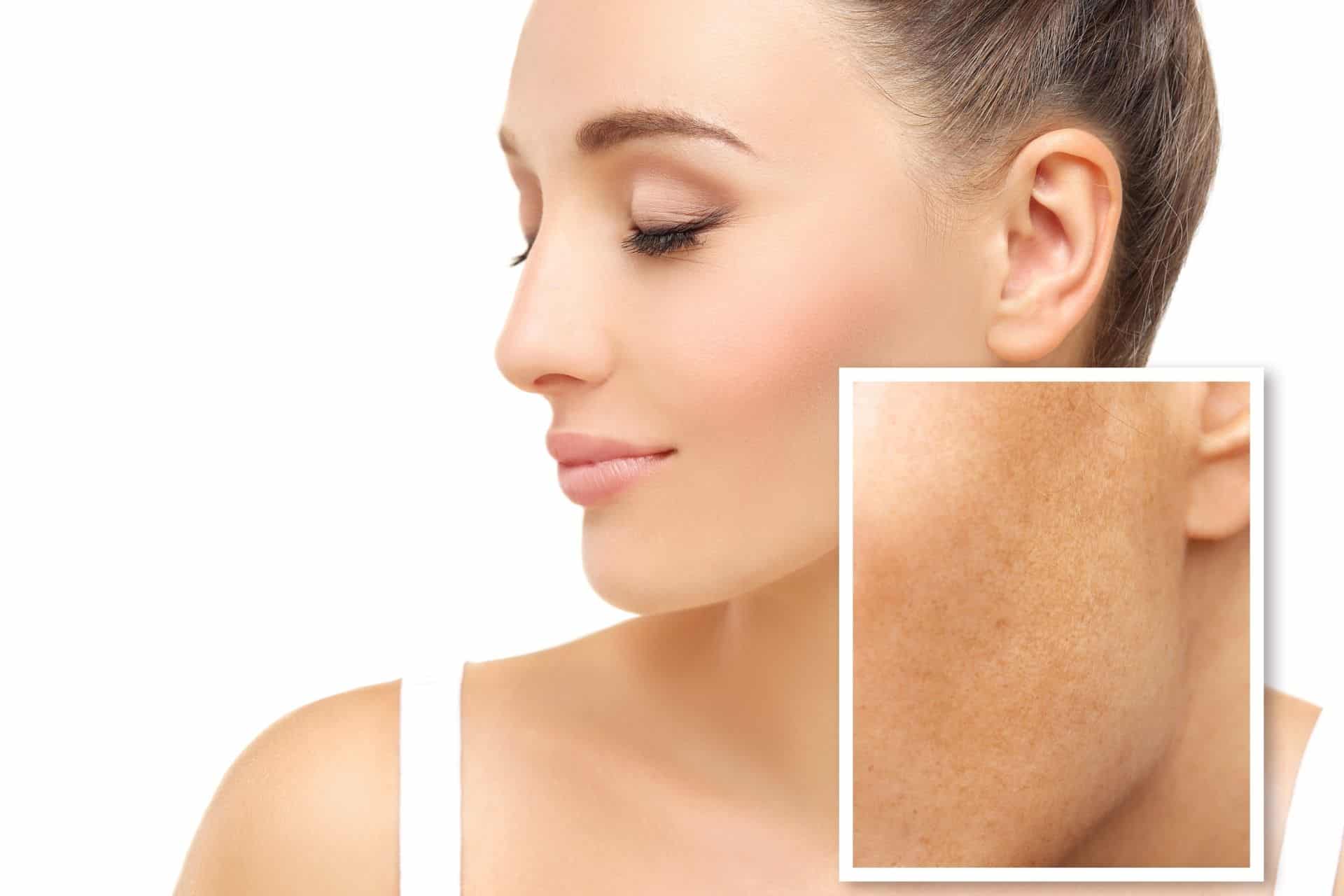 Radiofrequenz und CO₂-Laser